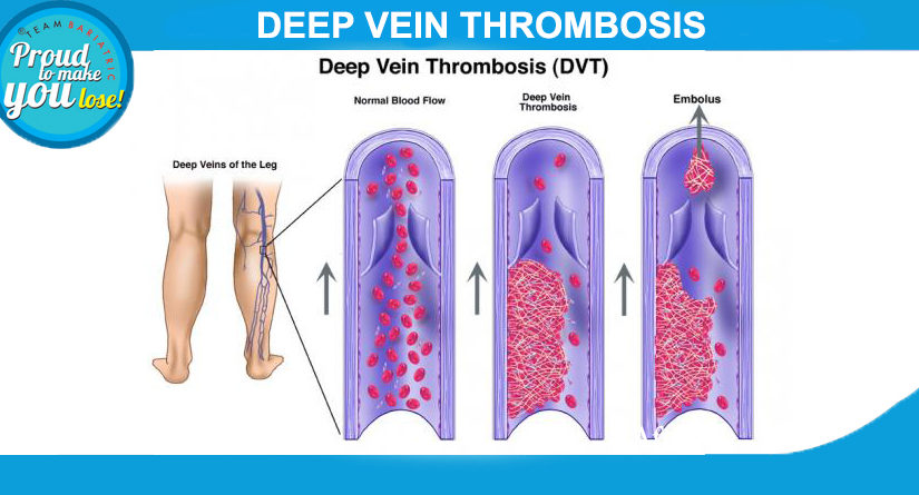 Deep Vein Thrombosis