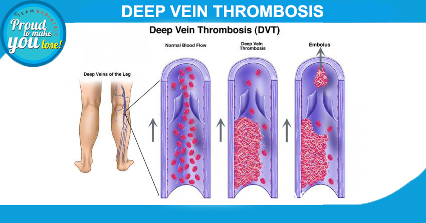 Deep Vein Thrombosis