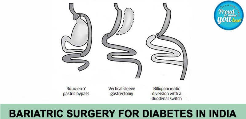 metabolic surgery for diabetes in India