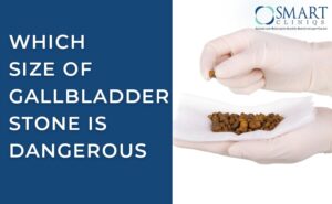 Which Size of Gallbladder Stone is Dangerous? {A Complete Guide} - Dr