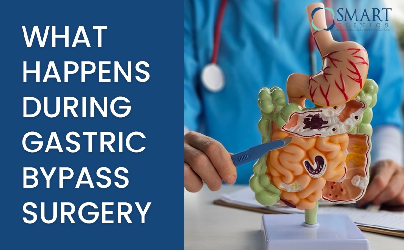 What happens during Gastric Bypass Surgery