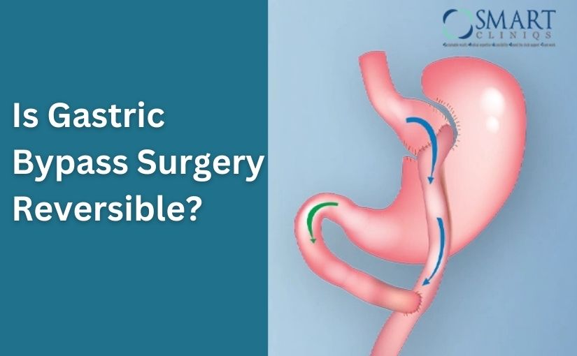 Is Gastric Bypass Surgery Reversible