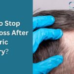 How to Stop Hair Loss After Bariatric Surgery