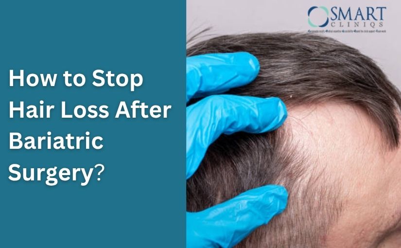 How to Stop Hair Loss After Bariatric Surgery