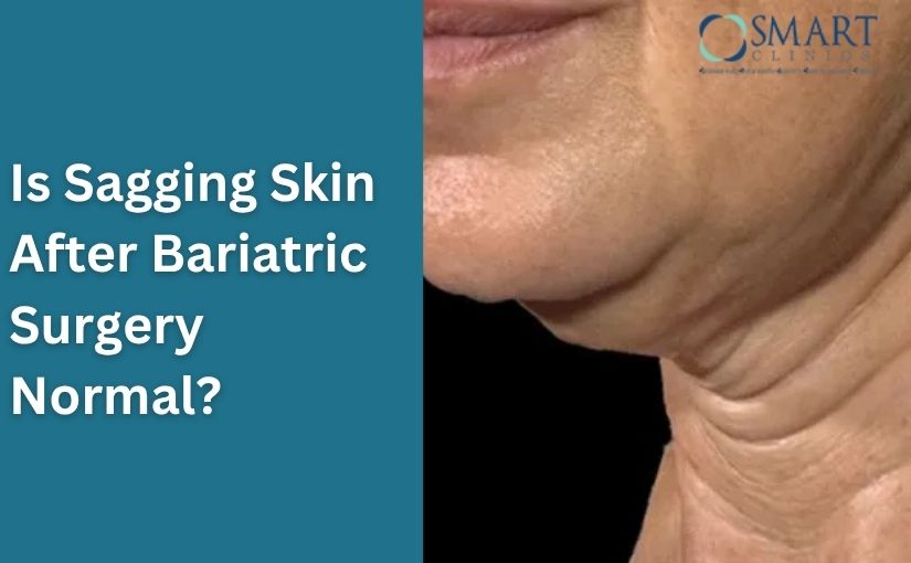 Is Sagging Skin After Bariatric Surgery Normal