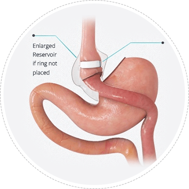 Banded Gastric Bypass