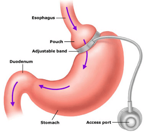 Laparoscopic Adjustable Gastric Banding