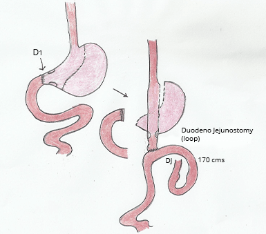 Laparoscopic Duodenojejunal Bypass