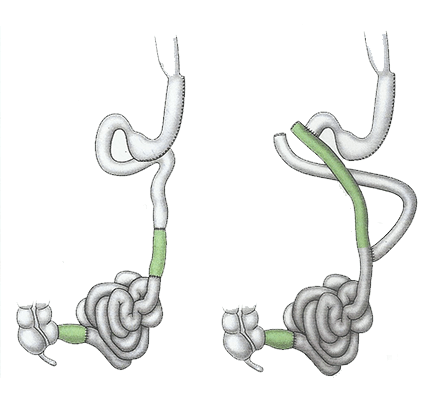 Laparoscopic Ileal Interposition