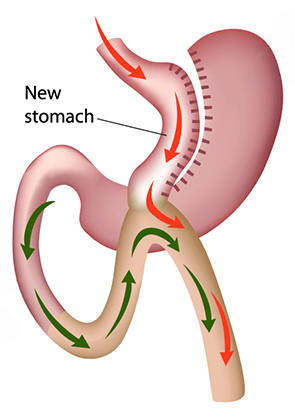 Mini Gastric Bypass Surgery