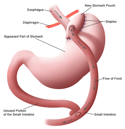 Laparoscopic Gastric Bypass Surgery